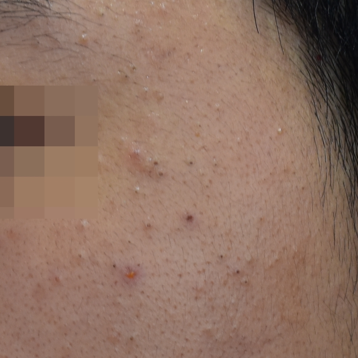 여드름과 유사한 피지성 병변 이미지